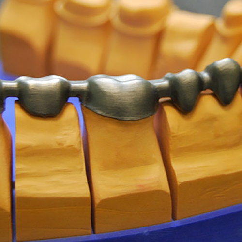 металлический каркас, изготовленный для мостовидного металлокерамического протеза