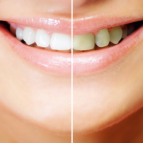 Фотоотбеливание зубов с помощью системы Beyond Polus соответствует американскому стандарту качества и на сегодняшний день является одним из наиболее эффективных методов